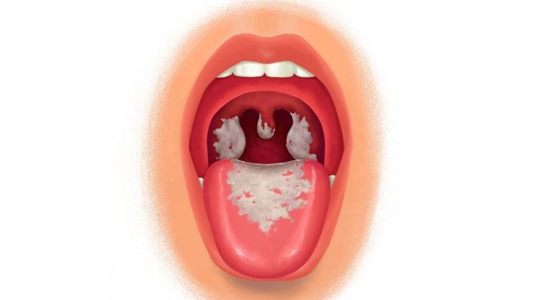 Đặc điểm, nguyên nhân, triệu chứng, đường lây truyền, cách phòng chống bệnh bạch hầu